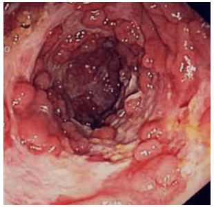 Crohn Hastalığı