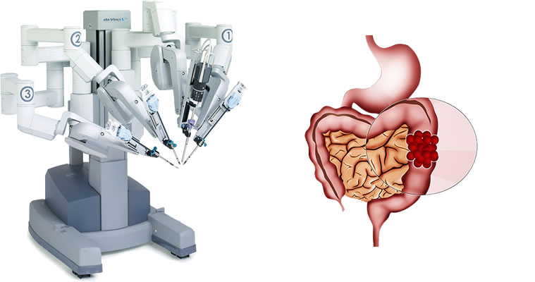 Robotik Kolon ve Rektum Kanseri Cerrahisi